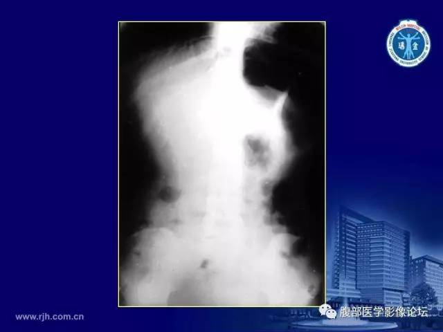 【PPT】急腹症