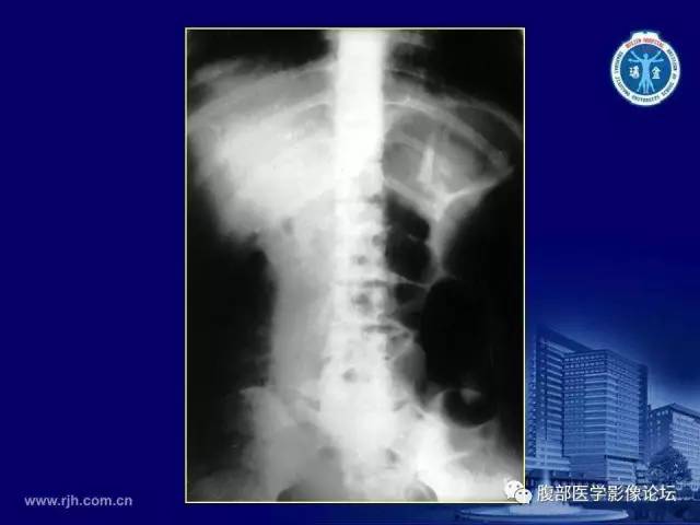 【PPT】急腹症