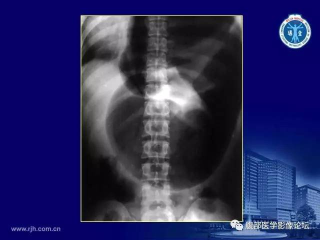 【PPT】急腹症