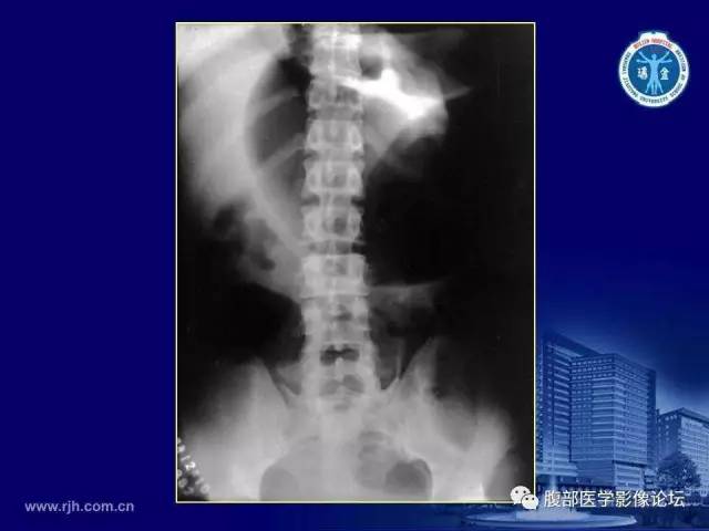 【PPT】急腹症