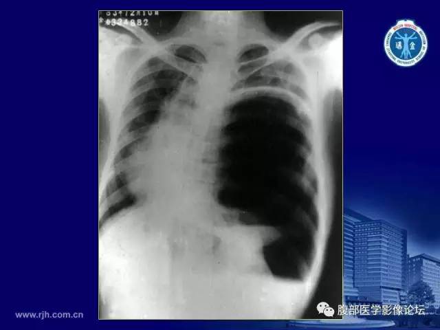 【PPT】急腹症
