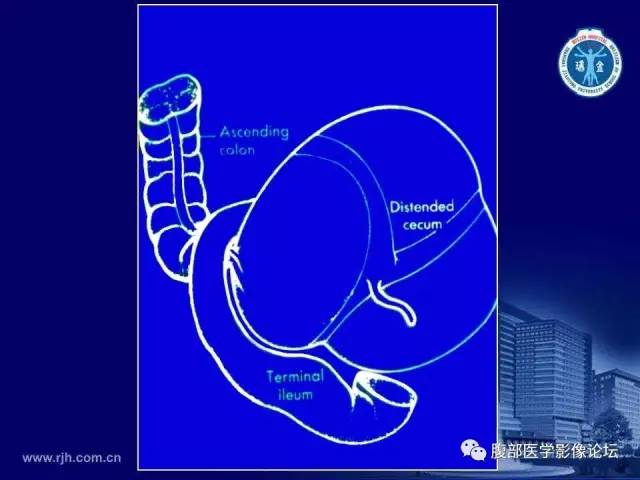 【PPT】急腹症