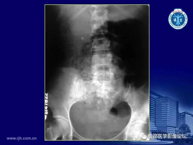 【PPT】急腹症