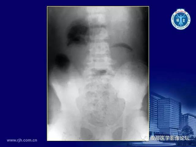 【PPT】急腹症
