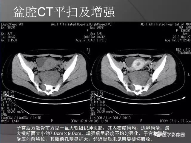 【病例】骶前节细胞神经瘤1例CT