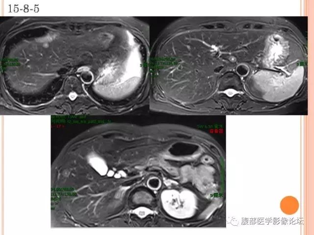 【病例】肝脏孤立性坏死结节ＳＮＮ一例MR