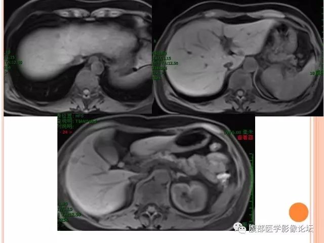 【病例】肝脏孤立性坏死结节ＳＮＮ一例MR
