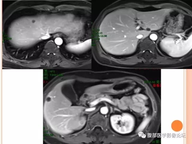 【病例】肝脏孤立性坏死结节ＳＮＮ一例MR