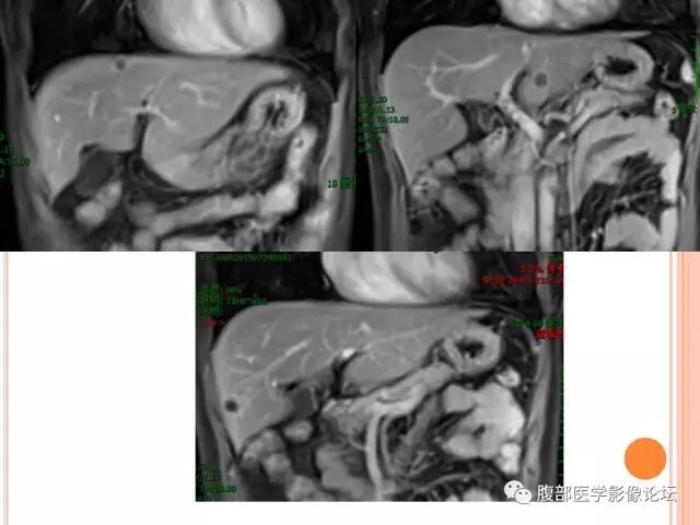 【病例】肝脏孤立性坏死结节ＳＮＮ一例MR