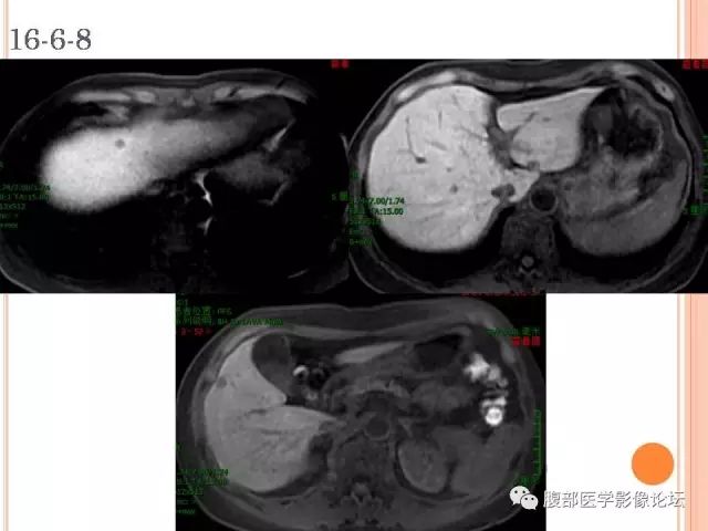 【病例】肝脏孤立性坏死结节ＳＮＮ一例MR