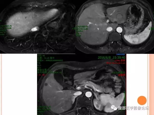 【病例】肝脏孤立性坏死结节ＳＮＮ一例MR