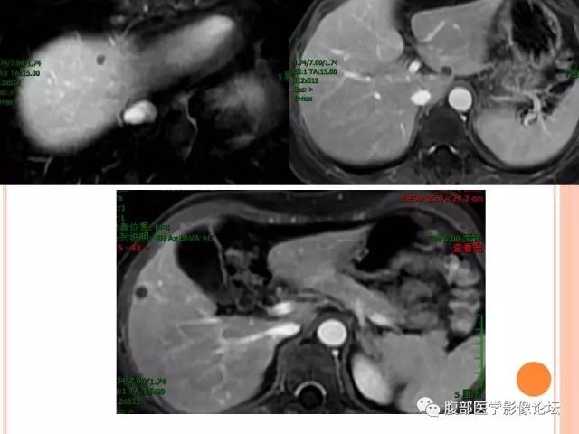 【病例】肝脏孤立性坏死结节ＳＮＮ一例MR