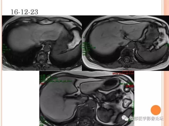【病例】肝脏孤立性坏死结节ＳＮＮ一例MR