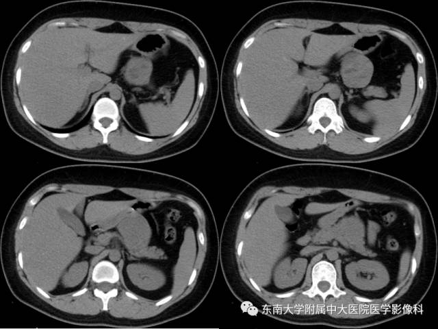 【病例】胰腺实性假乳状瘤1例CT影像表现
