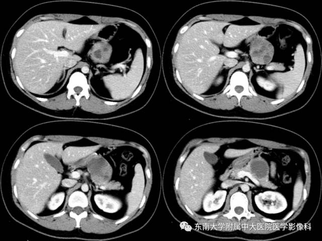 【病例】胰腺实性假乳状瘤1例CT影像表现