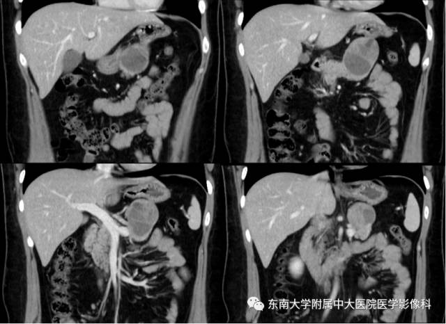 【病例】胰腺实性假乳状瘤1例CT影像表现