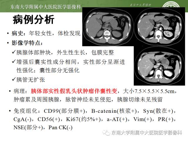 【病例】胰腺实性假乳状瘤1例CT影像表现