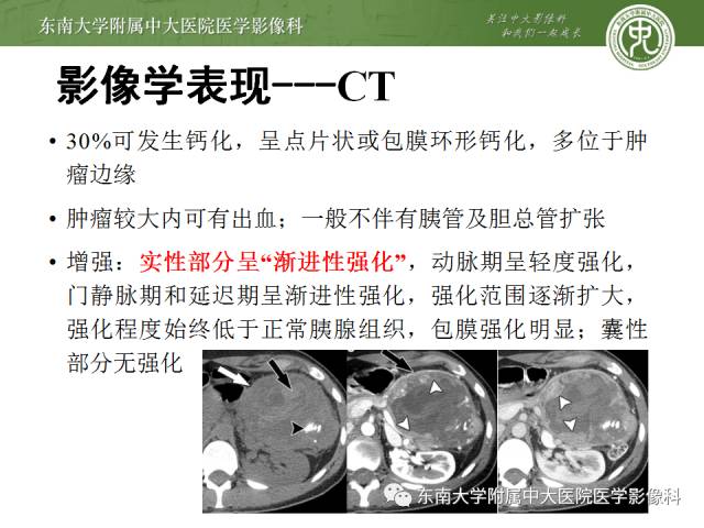 【病例】胰腺实性假乳状瘤1例CT影像表现