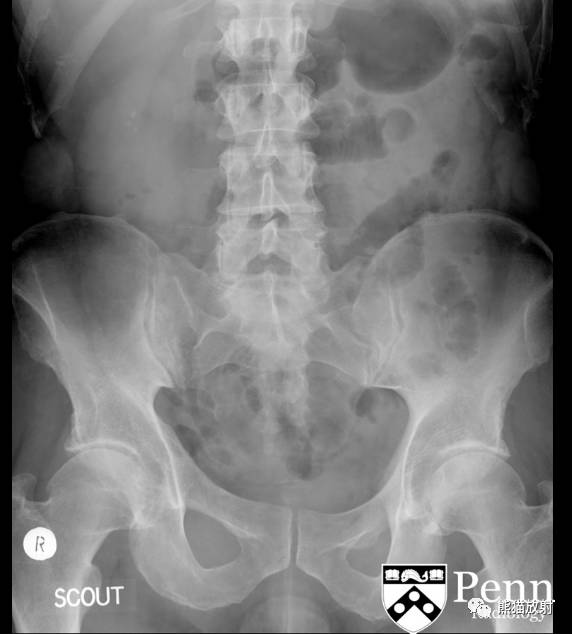 【双语病例】髓质海绵肾1例X线及CT鉴别诊断