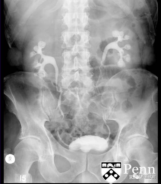 【双语病例】髓质海绵肾1例X线及CT鉴别诊断