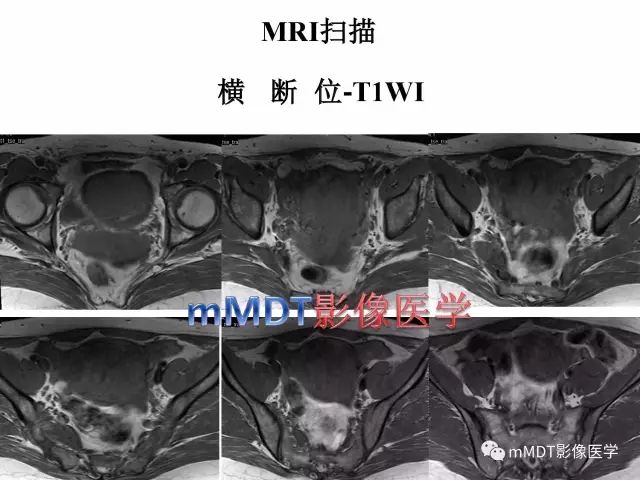 【病例】卵巢硬化性间质瘤1例MR