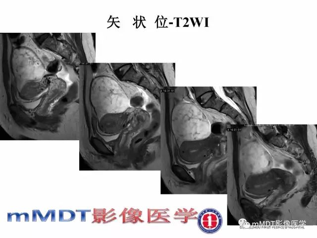 【病例】卵巢硬化性间质瘤1例MR