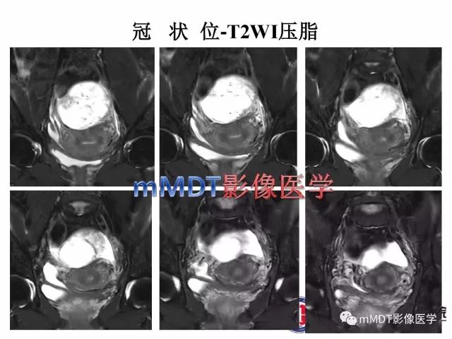 【病例】卵巢硬化性间质瘤1例MR