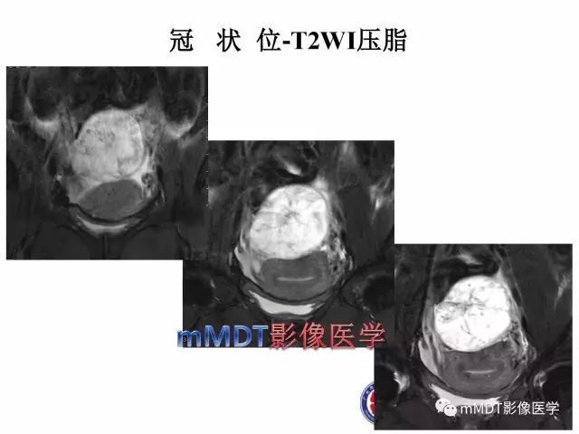 【病例】卵巢硬化性间质瘤1例MR