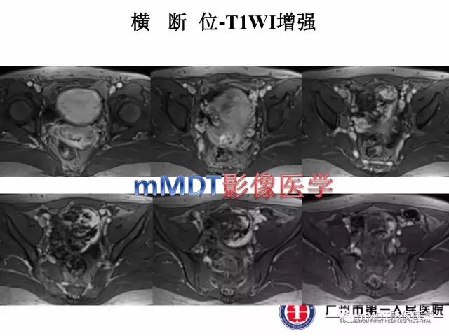 【病例】卵巢硬化性间质瘤1例MR