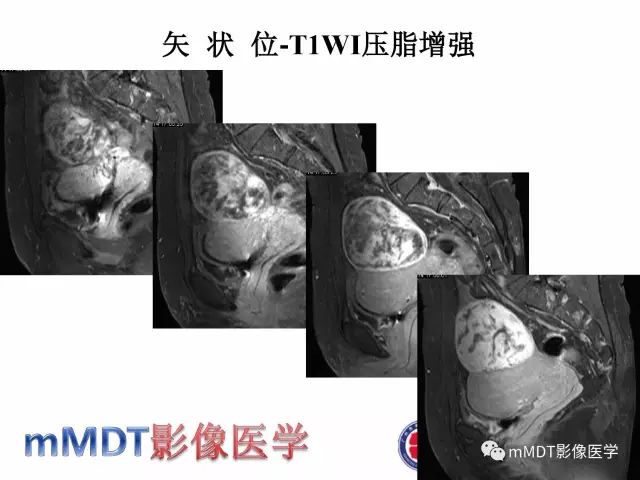【病例】卵巢硬化性间质瘤1例MR