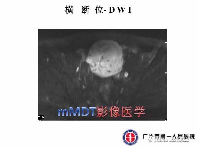 【病例】卵巢硬化性间质瘤1例MR