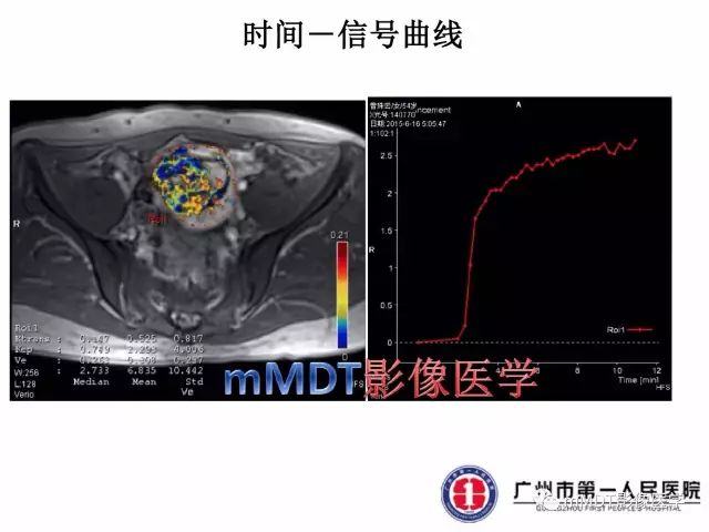 【病例】卵巢硬化性间质瘤1例MR