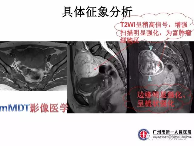 【病例】卵巢硬化性间质瘤1例MR