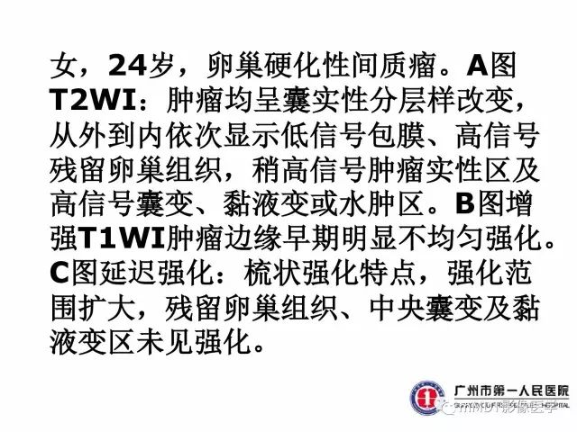 【病例】卵巢硬化性间质瘤1例MR