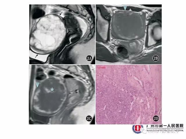 【病例】卵巢硬化性间质瘤1例MR