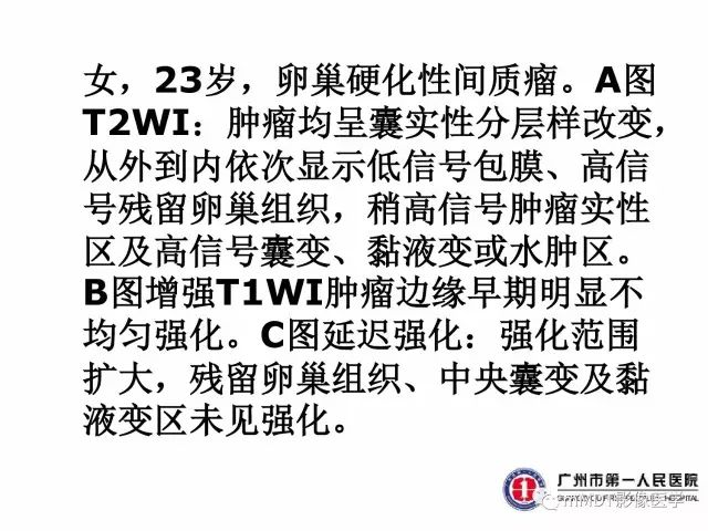【病例】卵巢硬化性间质瘤1例MR