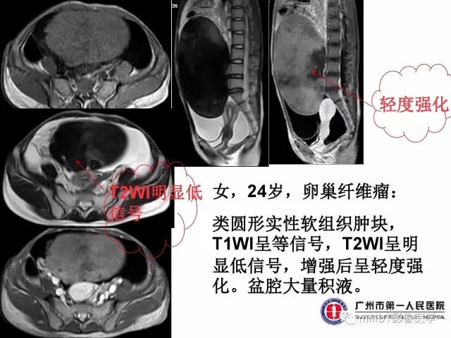 【病例】卵巢硬化性间质瘤1例MR