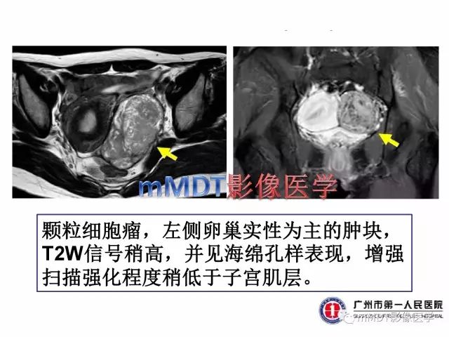 【病例】卵巢硬化性间质瘤1例MR