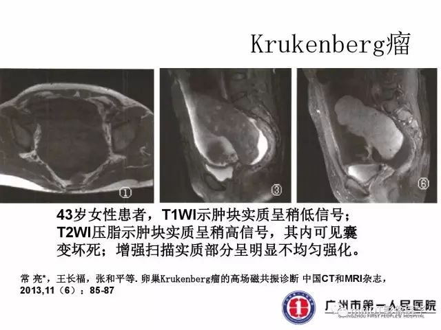 【病例】卵巢硬化性间质瘤1例MR
