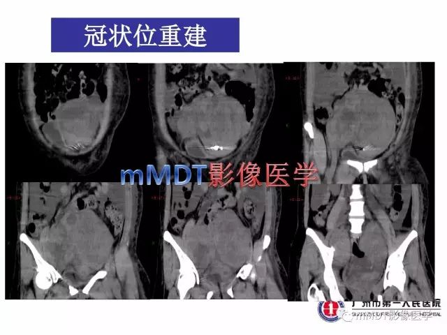 【病例】卵巢PNET1例CT及MR