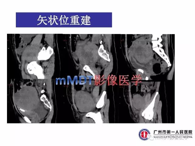 【病例】卵巢PNET1例CT及MR
