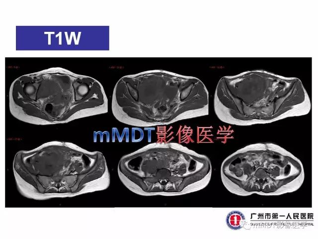 【病例】卵巢PNET1例CT及MR
