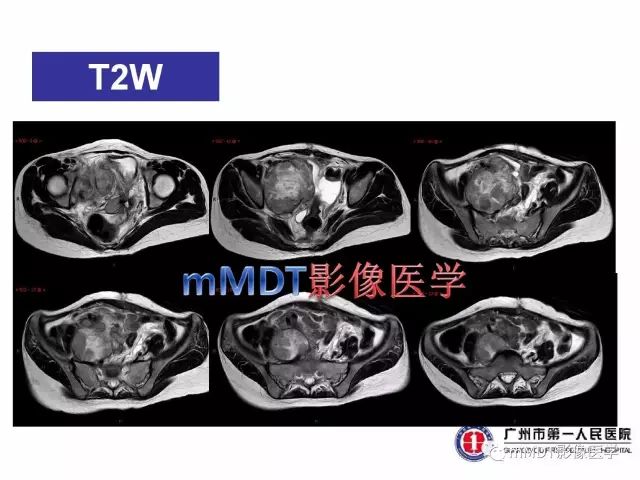 【病例】卵巢PNET1例CT及MR
