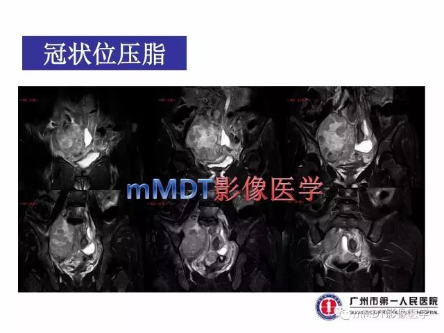【病例】卵巢PNET1例CT及MR