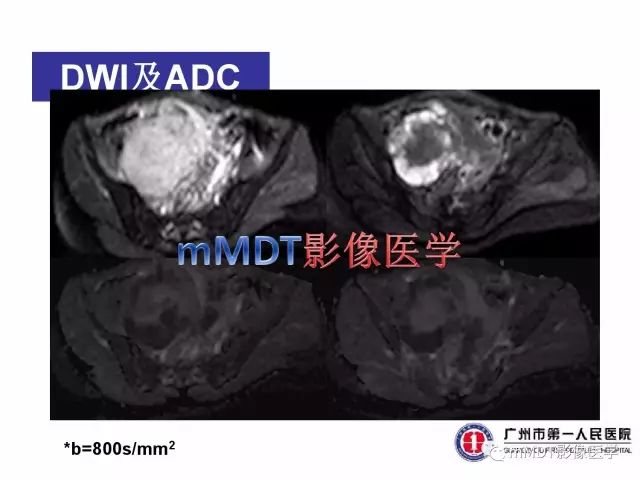 【病例】卵巢PNET1例CT及MR