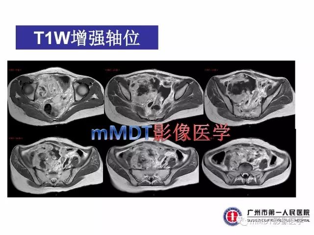 【病例】卵巢PNET1例CT及MR