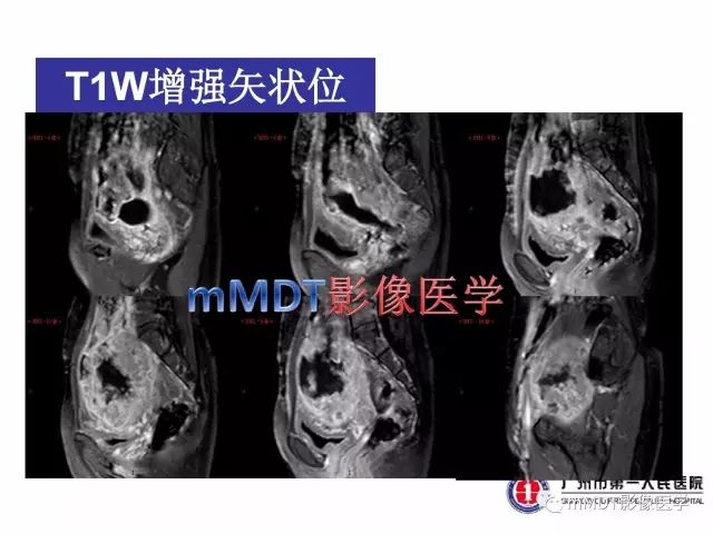【病例】卵巢PNET1例CT及MR