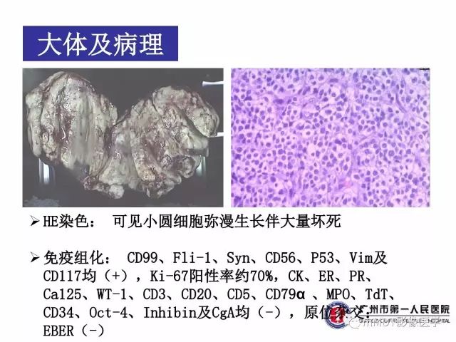 【病例】卵巢PNET1例CT及MR