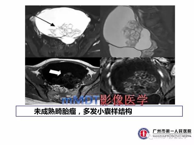 【病例】卵巢PNET1例CT及MR