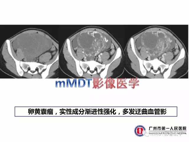 【病例】卵巢PNET1例CT及MR